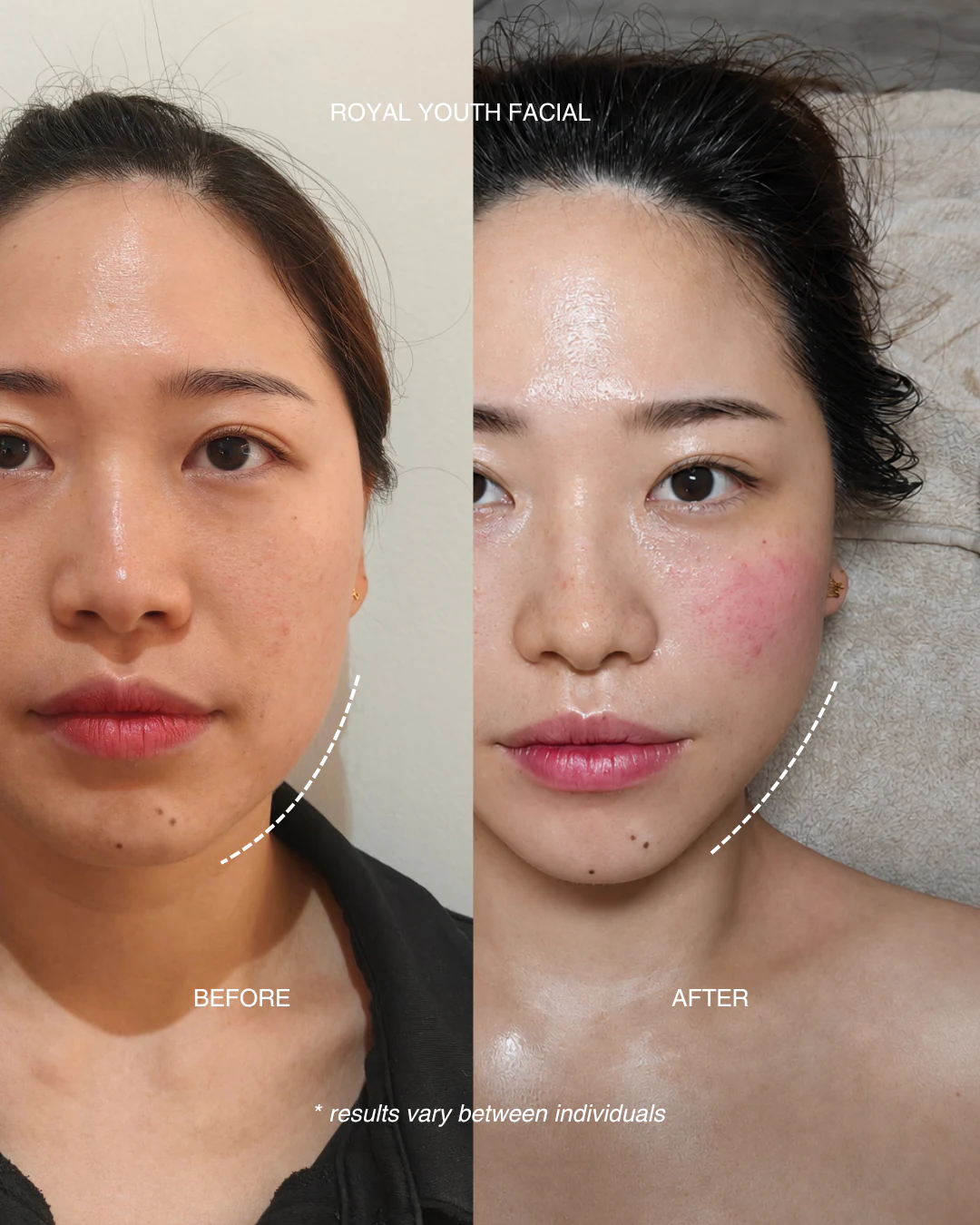 Before and after results of the Royal Youth Facial at Zen Beauty