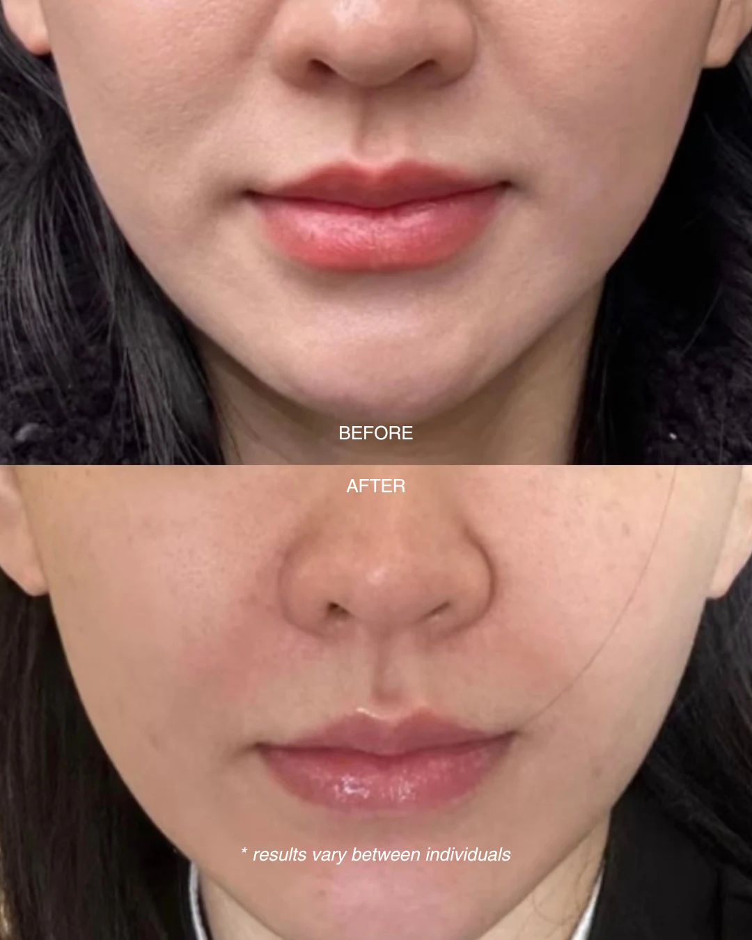 Before and after an RF Lifting Facial showing lifted cheeks and softened laugh lines