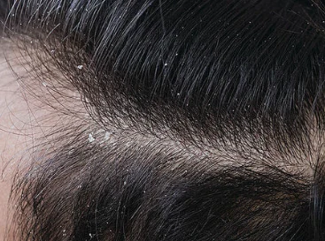 Dandruff & flaking