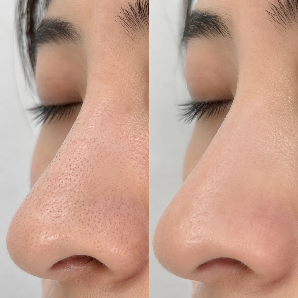 Before and after comparison of congested nose pores following the Purifying Facial Treatment